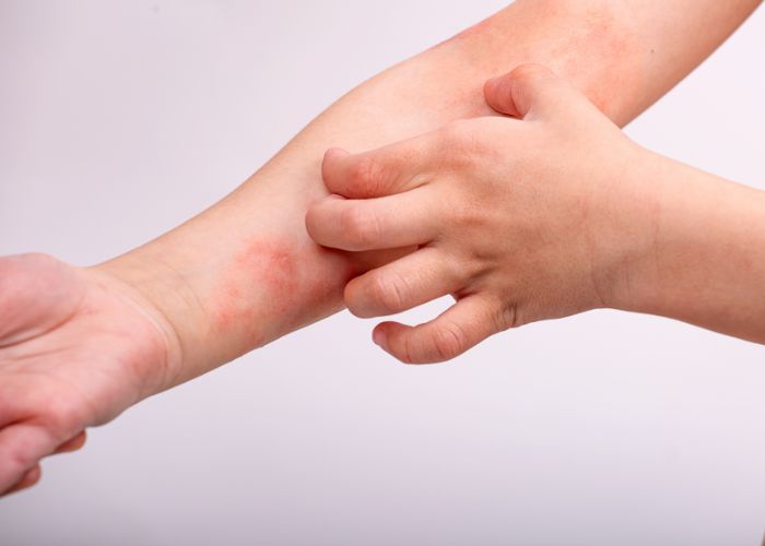 Neurodermitis: Kind kratzt sich juckende Haut am Unterarm