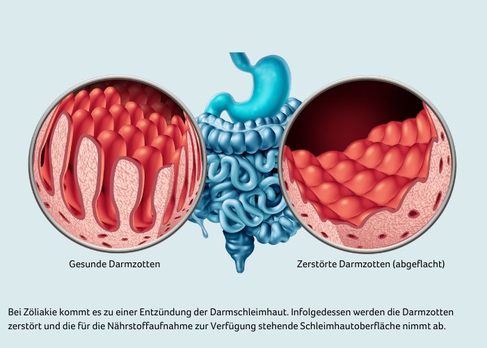 grafische darstellung von gesunden Darmzotten sowie von Darmzotten, die durch Zöliakie zerstört werden