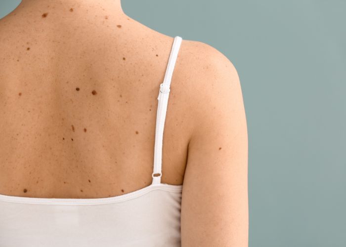 Muttermale Untersuchung