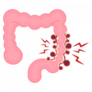 colitis ulcerosa ulcerative colitis