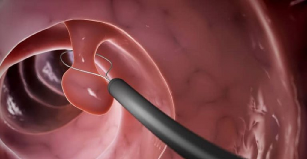 La coloscopie : un examen pour retirer les polypes