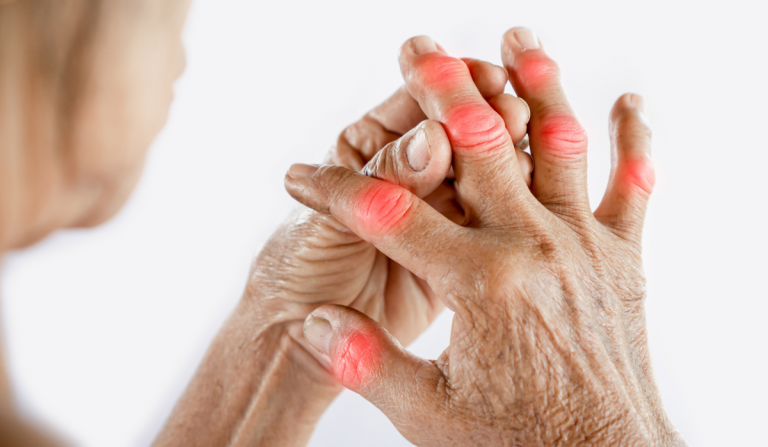 goutte acide urique douleurs