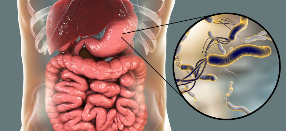 Gastrite de type B : l'inflammation bactérienne de la muqueuse gastrique causée par Helicobacter pylori
