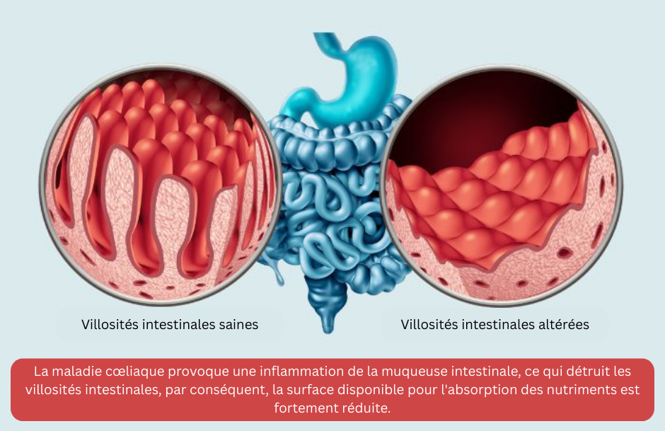 Comment savoir si j'ai la maladie cœliaque ?