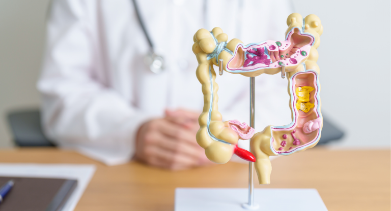 divertikel, divertikulitisz, vastagbél-divertikulosis tünetei, vastagbél-divertikulosis kezelése, omni-biotic, probiotikum