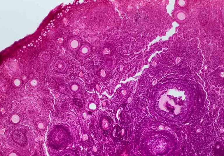 bélbaktériumok, hormonok, hormonváltozás, hormonbetegség, PCOS tünetei, PCOS kezelése, probiotium, omni-biotic, női probiotikum