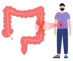 sindrome dell'intestino irritabile