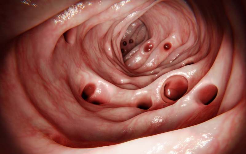 diverticoli-fermenti-lattici-probiotici