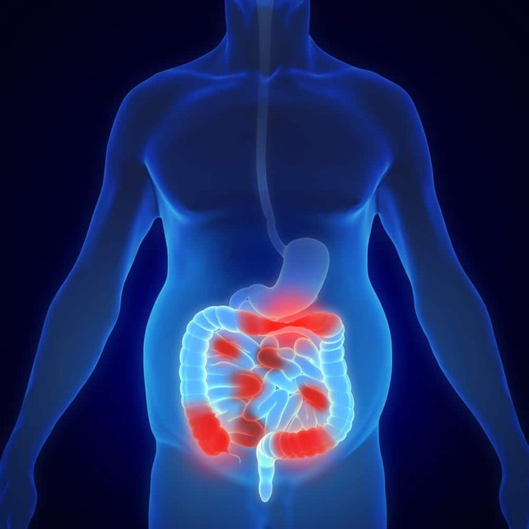 Schweizer Studie zu chronischen Darmerkrankungen (IBD)